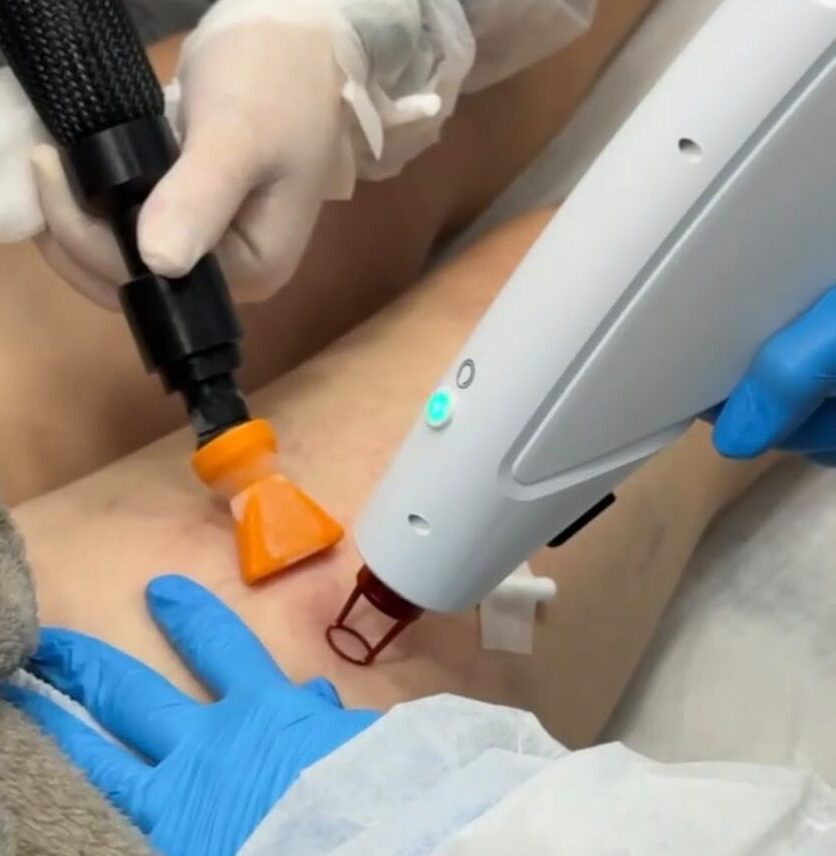 laser transdérmico para varizes